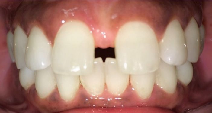 INVISALIGN in Marina Del Rey