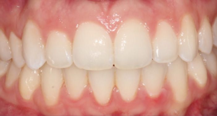 INVISALIGN in Marina Del Rey