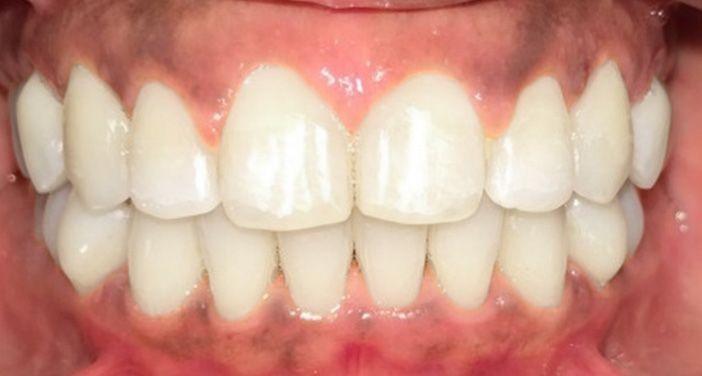 INVISALIGN in Marina Del Rey