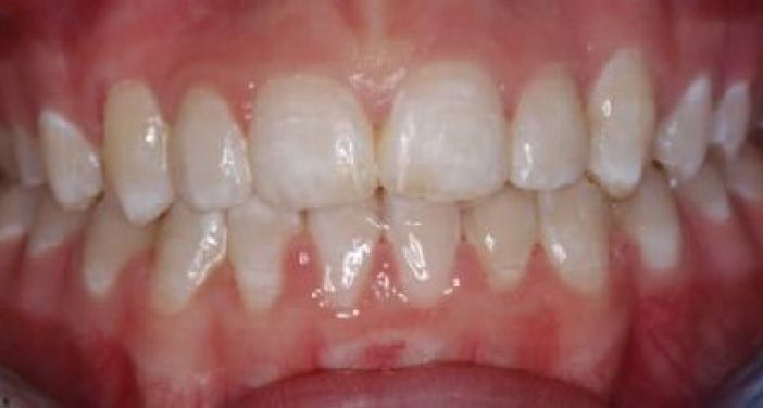 INVISALIGN in Marina Del Rey