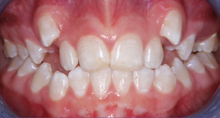 INVISALIGN in Marina Del Rey